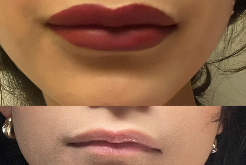 Lip Enhancement