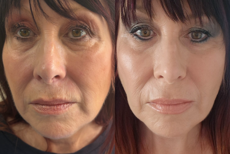 Skin Boosters (Profhilo / Injectable Hydration)