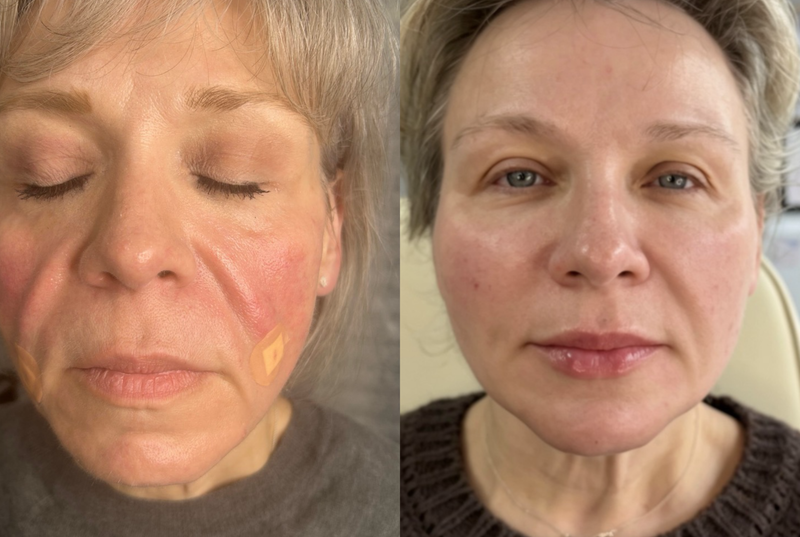 Facial Harmonisation Treatment